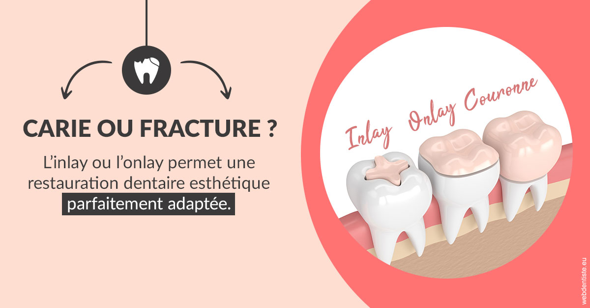 https://selarl-ercd.chirurgiens-dentistes.fr/T2 2023 - Carie ou fracture 2
