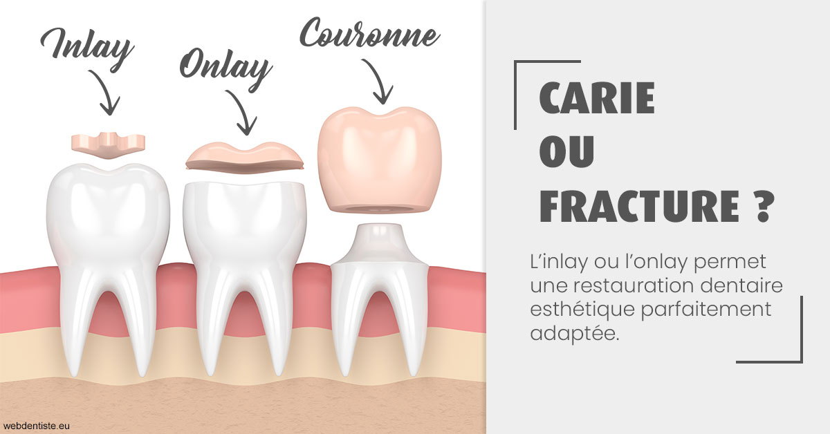 https://selarl-ercd.chirurgiens-dentistes.fr/T2 2023 - Carie ou fracture 1