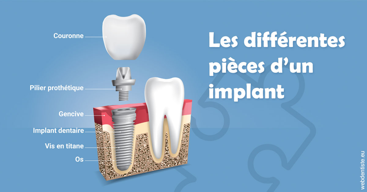 https://selarl-ercd.chirurgiens-dentistes.fr/Les différentes pièces d’un implant 1